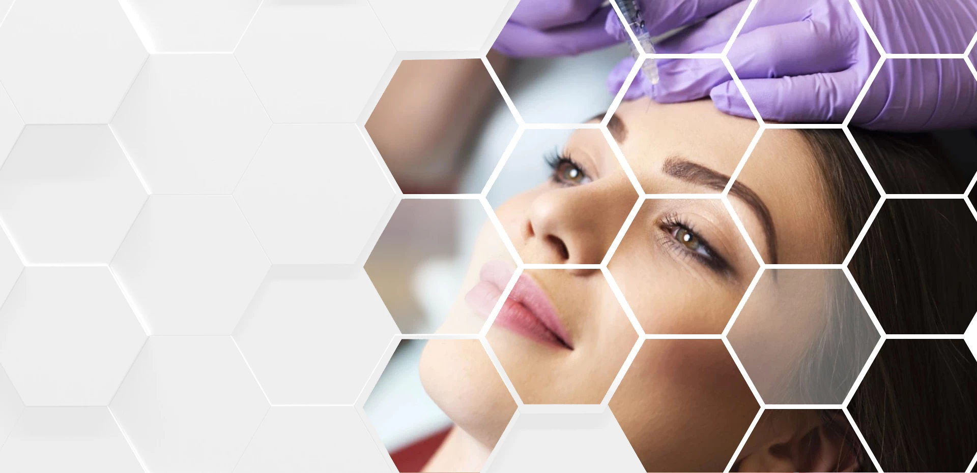 wypełnianie zmarszczek na&nbsp;czole